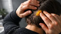 Kurkuma gegen Schuppen: so beruhigst du juckende Kopfhaut in 4 einfachen Schritten